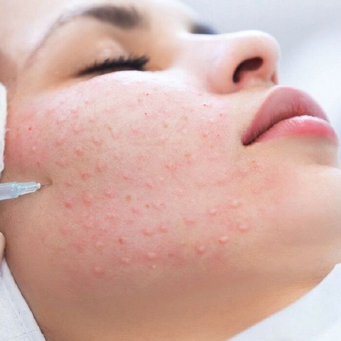 МЕЗОТЕРАПИЯ